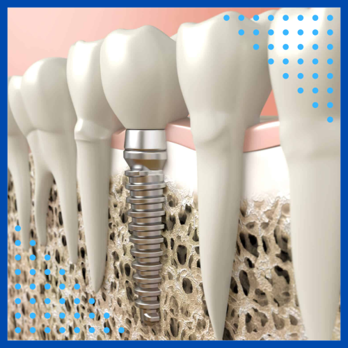 Odontoclinic - Enxerto Ósseo